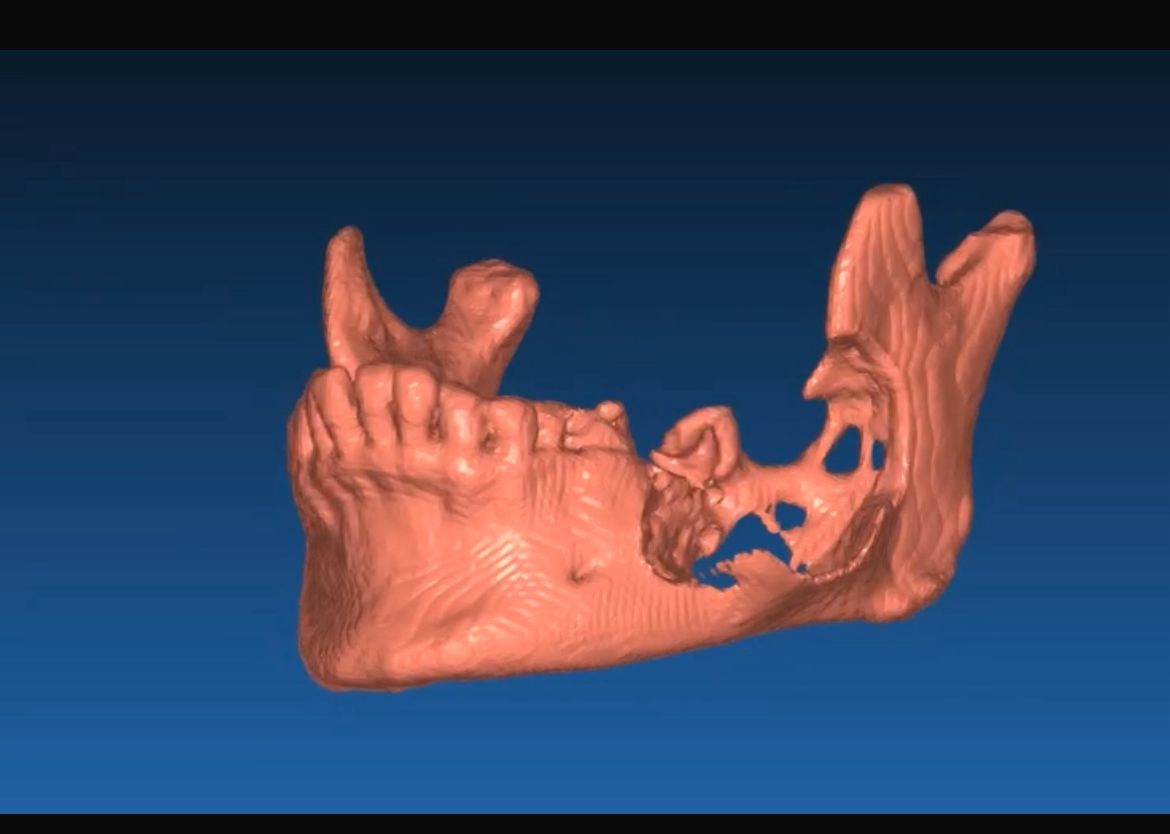AMELOBLASTOMA MANDIBLE MODEL